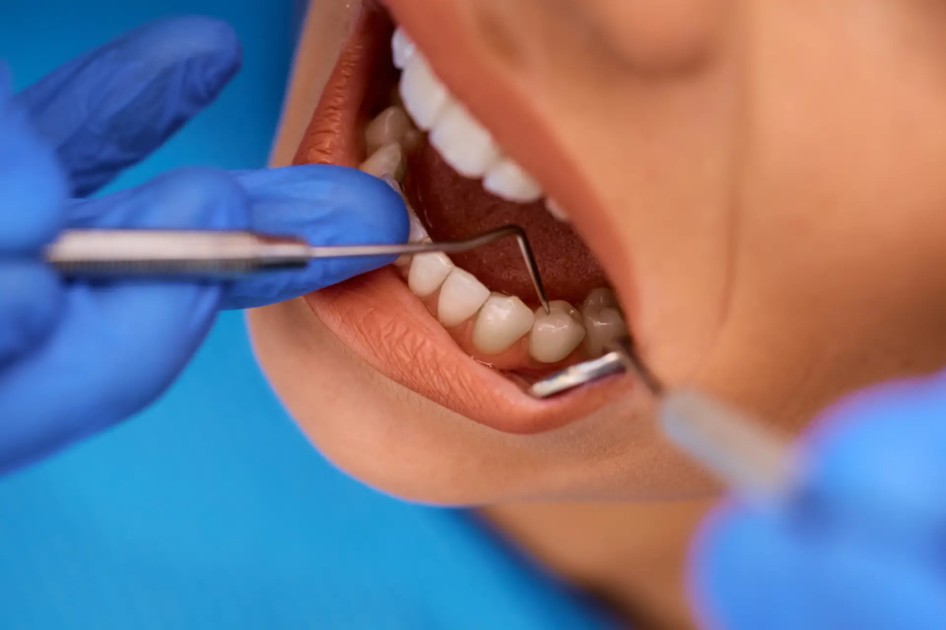 Tooth Fillings